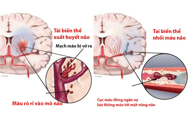 tai biến mạch máu não phác đồ điều trị