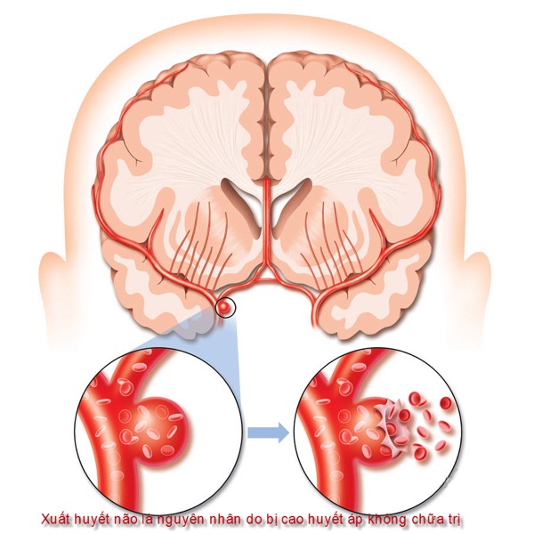 tai biến mạch máu não phác đồ