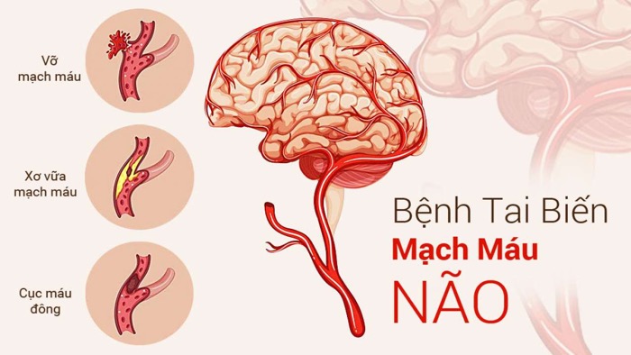 tai biến mạch máu não sống được bao lâu