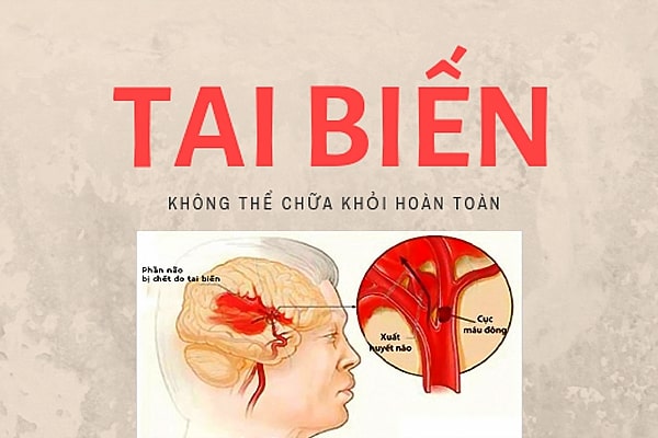 tai biến mạch máu não thoáng qua