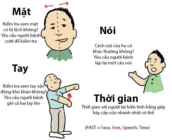 tai biến mạch máu não tiếng anh là gì