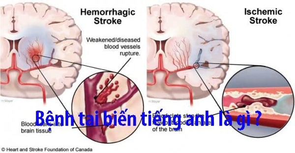 tai biến mạch máu não tiếng anh