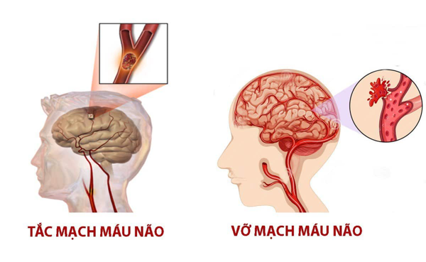 tai biến mạch máu não tiếng pháp