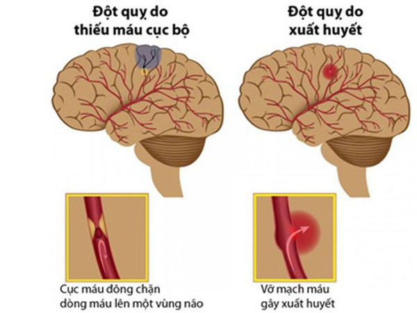 tai biến mạch máu não tiếng trung