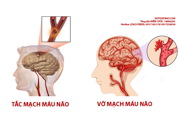 tai biến mạch máu não và cách chữa trị