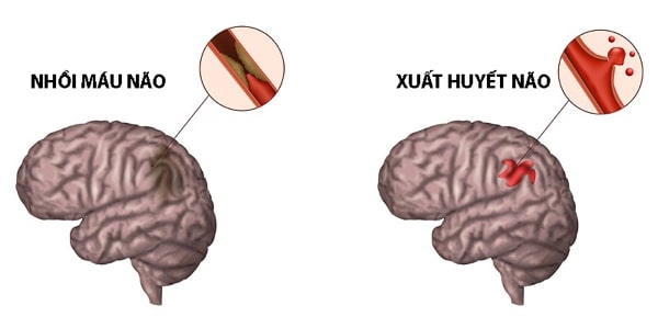 tai biến mạch máu não