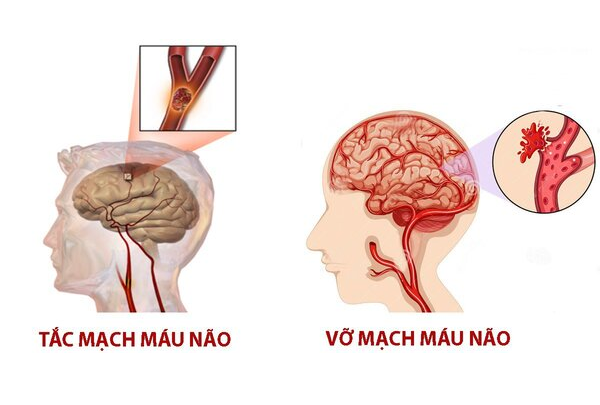 thuốc uống ngừa tai biến mạch máu não