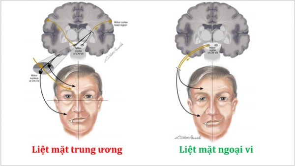 Xử lý khi bị tai biến mạch máu não