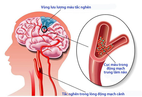 Xử trí tai biến mạch máu não tại nhà